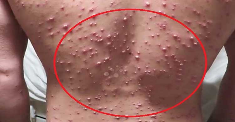 চিকেন পক্স