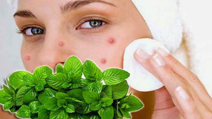 ব্রণ সারাতে পুদিনা পাতা ব্রণ