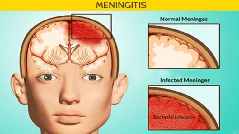 meningitis